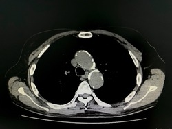 CT scan (Computed tomography) of chest organs and calcified at aorta