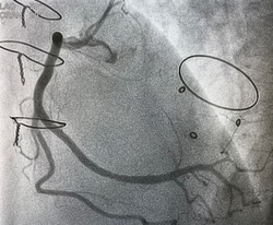Coronary artery angiogram was performed normal right coronary artery (RCA)