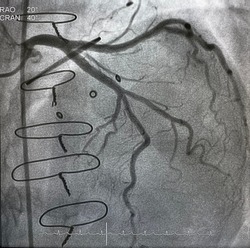 Coronary artery angiogram was performed normal left coronary artery