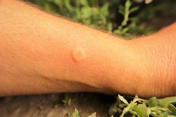 Skin allergy, allergic.
Yellow wasp : stung by a wasp worker.
Yellow hornet stings a man's arm.
It's also called a German wasp or European wasp.
Yellowjacket or yellow jacket.
Wasps, insects, insect