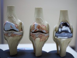 model of knee joint showing multiple stages of knee osteoarthritis and total knee replacement or arthroplasty. 