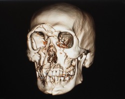 3d reconstruction computer tomography or CT scan image showing severe fracture of the face after an accident. Le fort fracture.