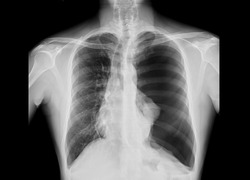 Chest x-ray showing tension pneumothorax on the left side of lung. The pathology cause pressure effect and midline shift of the heart and trachea. The patient needs emergent chest tube drainage.
