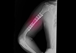 A radiograph of right arm showing closed fracture at shaft of humerus bone. The patient also had radial nerve palsy. He underwent open reduction and internal fixation with plate and screws.
