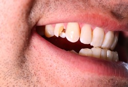 A chipped tooth is a tooth that has broken. A small or large piece may have been knocked off through a fall, sports injury, or other trauma to the mouth, including biting something hard. 