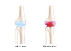 Knee osteoarthritis. Arthritis or degenerative joint disease. Cartilage becomes worn. Results in inflammation swelling. Medical healthcare concept. Isolated on white background. Realistic 3d Vector.