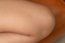 Woman leg skin showing early symptoms and warning signs of varicose veins.