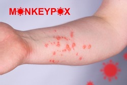 Hand of a young guy in a rash. Monkeypox virus symptoms.