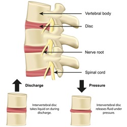 Vertebral body and disc anatomy and functionality on pressure medical vector illustration eps 10