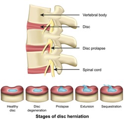 Stages of disc herniation spine and disc anatomy 3d medical vector illustration eps 10