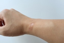 Keloid scar on young man right wrist caused by operation.