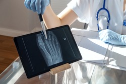 Orthopedic doctor show x-ray radiography on tablet. Fracture of the leg or foot. Concept of rehabilitation and healing physiotherapy. Orthopedics and Traumatology.