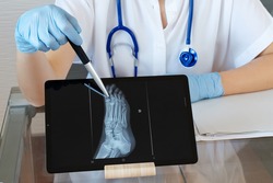 Orthopedic doctor show x-ray radiography on tablet. Fracture of the leg or foot. Concept of rehabilitation and healing physiotherapy. Orthopedics and Traumatology.