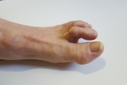This is what a hammer toe looks like.