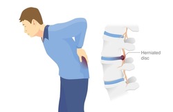 Man has low back pain and sciatica from a herniated disc. Medical diagrams about trapped nerves make patients chronic pain in the back and paralysis.