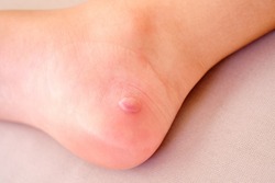 detail of the heel of a girl with a reddened blister
