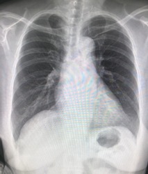 Chest X-ray shows the heart in slight LT ventricular enlarged, tortuous aorta and calcified aortic knob. The mediastinum, ribs and diaphanous are normal. Both lungs are clear. No active chest disease.