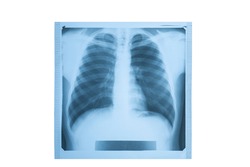 X-ray film of lungs on a white background. lung radiography concept. X-ray of a thorax.