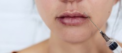 Plastic lips. Women's lips after injections of hyaluronic acid. Complications after lip augmentation, close-up scars and bruises.