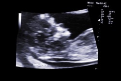 first trimester ultrasound baby xray of Fraternal twin face profile
