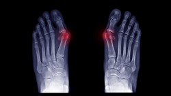 Film X-ray foot radiograph show both Hallux valgus deformity or Bunion disease. The patient has big toe pain symptom ,shoe wearing and cosmetic problem. Highlight on painful area. Medical concept