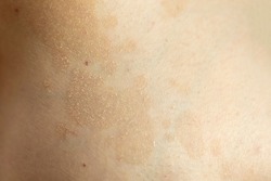 Tinea versicolor (pityriasis versicolor), a fungal or yeast skin rash caused by too much growth of yeast, causing discoloration and patches. Skin problem, dermatology concept