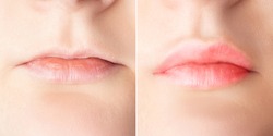 Lip augmentation before and after close up. Woman lips surgery, filler injection, mesotherapy, correction.