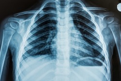 View of a child x-ray film, taken to examine the lungs