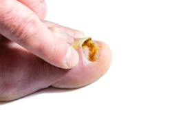 Tearing a broken and decomposed big toe nail by the index finger isolated on the white background.