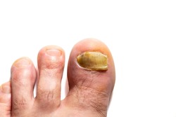 Closeup of a male foot part with a broken and decomposed big toe nail isolated on the white background.
