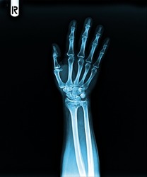 film  X-ray hand and finger 