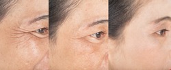 Wrinkles on the eyes.  and before and after melasma  and freckles  facial treatment on face  skin Problem and  make-up in women
