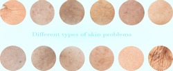 Different types of skin problems and wrinkles around the eyes and face. Dark spots. Melasma and freckles