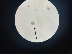 Eggs of Ascaris lumbricoides (roundworm) in stool, analyze by microscope
