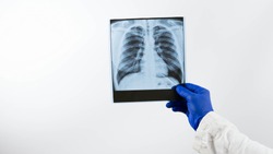 X-ray of human lungs on a white background in the hands of a doctor.Pneumonia of the lungs, infection,a medical professional is engaged in x-ray diffraction,diagnoses and concludes the patient.