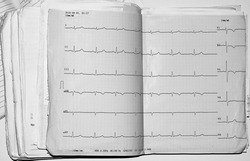 cardiogram of the heart on paper in the case history