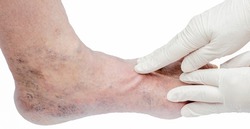 Doctor in white gloves holding man's foot and pointing to varicose veins, deep vein thrombosis, venous injuries on foot. Healthy varicose ulcer. Isolated on white background.