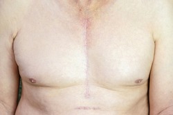 Shirtless Caucasian man with scar mark from CABG (Coronary Artery Bypass Graft) on his chest. Open heart surgery. Healthy scar.