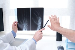 Young doctor examining x-ray of hands of a senior patient with arthritis. Radiography of a hand.