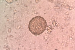 This is hymenolepis diminuta egg by microscopic . causing gastrointestinal disease.