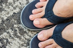 An ingrown nail occurs when the nail itself grows into the skin. Surgery to cut away the ingrown toe nail on the left side of of the big toe of the RIGHT FOOT 2 years ago leads to no more painful toe.