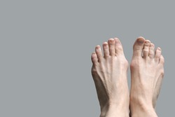 Hallux valgus, bursitis of the foot on a gray background. Deformation of the joints of the foot.