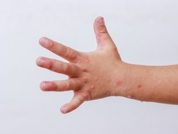 Hand-foot-and-mouth disease HFMD human hand of scarlet fever on palm enterovirus Coxsackie virus isolated on white background.