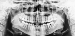 Panoramic dental x-ray of the oral cavity with teeth