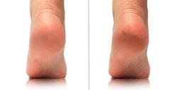Image before and after feet dry skin cracked heel treatment. Cracked heels before and after treatment and treatment. Medical pedicure in a beauty salon. Problematic dehydrated feet with dry skin.