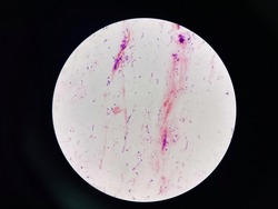 Mixed organism Bacteria cell in sputum sample Gram stain method.