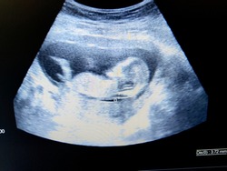 increased nuchal translucency in fetus by ultrasound