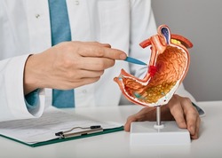 Gastroenterologist consultation, treatment of stomach diseases and ulcers. Doctor pointing to gastric ulcer on anatomical model of stomach