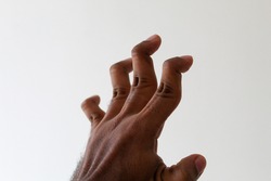 young man with a hyper extension fingers, hyper mobility fingers, swan neck deformity, It is commonly caused by injury or inflammatory conditions like rheumatoid arthritis or sometimes familial.
