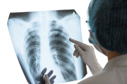 A female doctor or radiologist examines a chest x-ray of a patient in a hospital. Pulmonology and cardiothoracic surgery concept. Control and monitoring of diseases of the lungs and respiratory organs